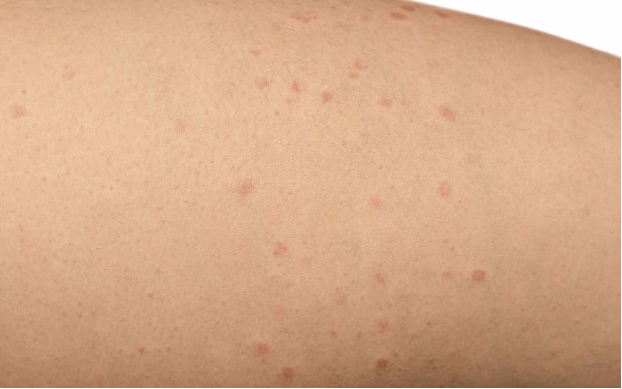 Comment prévenir et traiter les brûlures liées à l'épilation laser