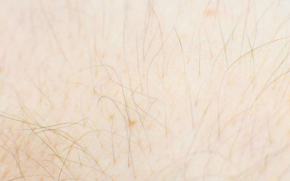 L’épilation laser, ça marche sur les poils blonds ou roux ?