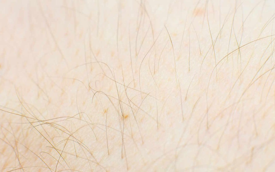 L’épilation laser, ça marche sur les poils blonds ou roux ?