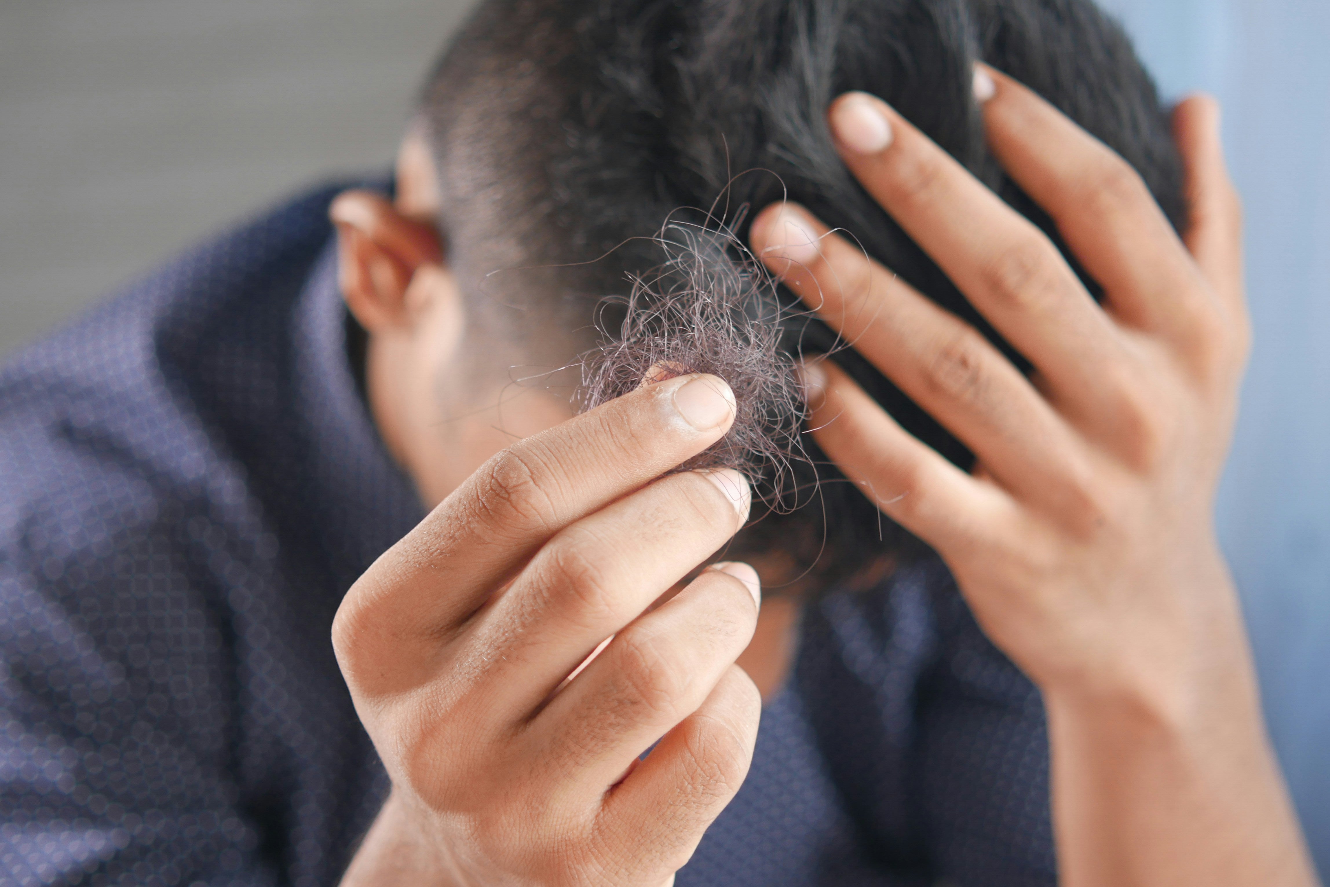 Les causes de la perte de cheveux les plus fréquentes