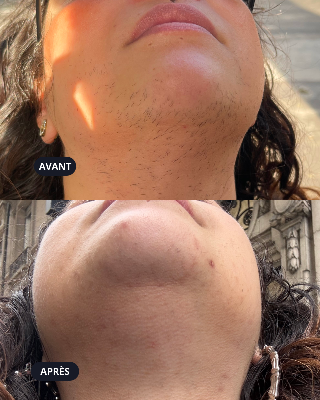 -50% sur 10 séances d’épilation laser pour 3 zones au choix