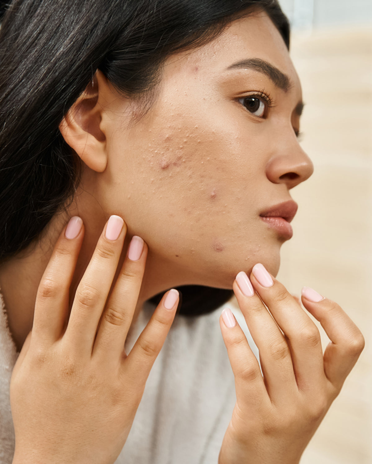 Femme touchant son visage marqué par de l'acné adulte