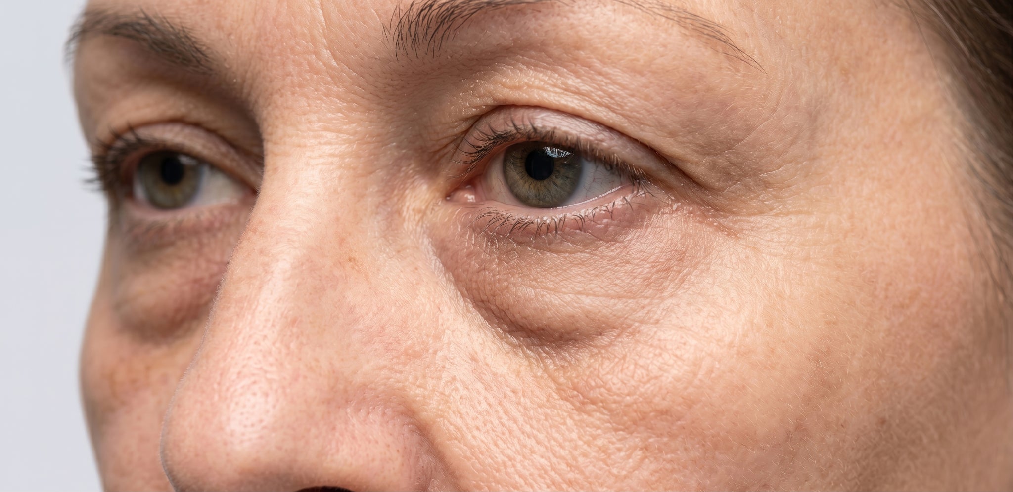 Poches sous les yeux liées à une rétention d'eau ou une accumulation de graisse