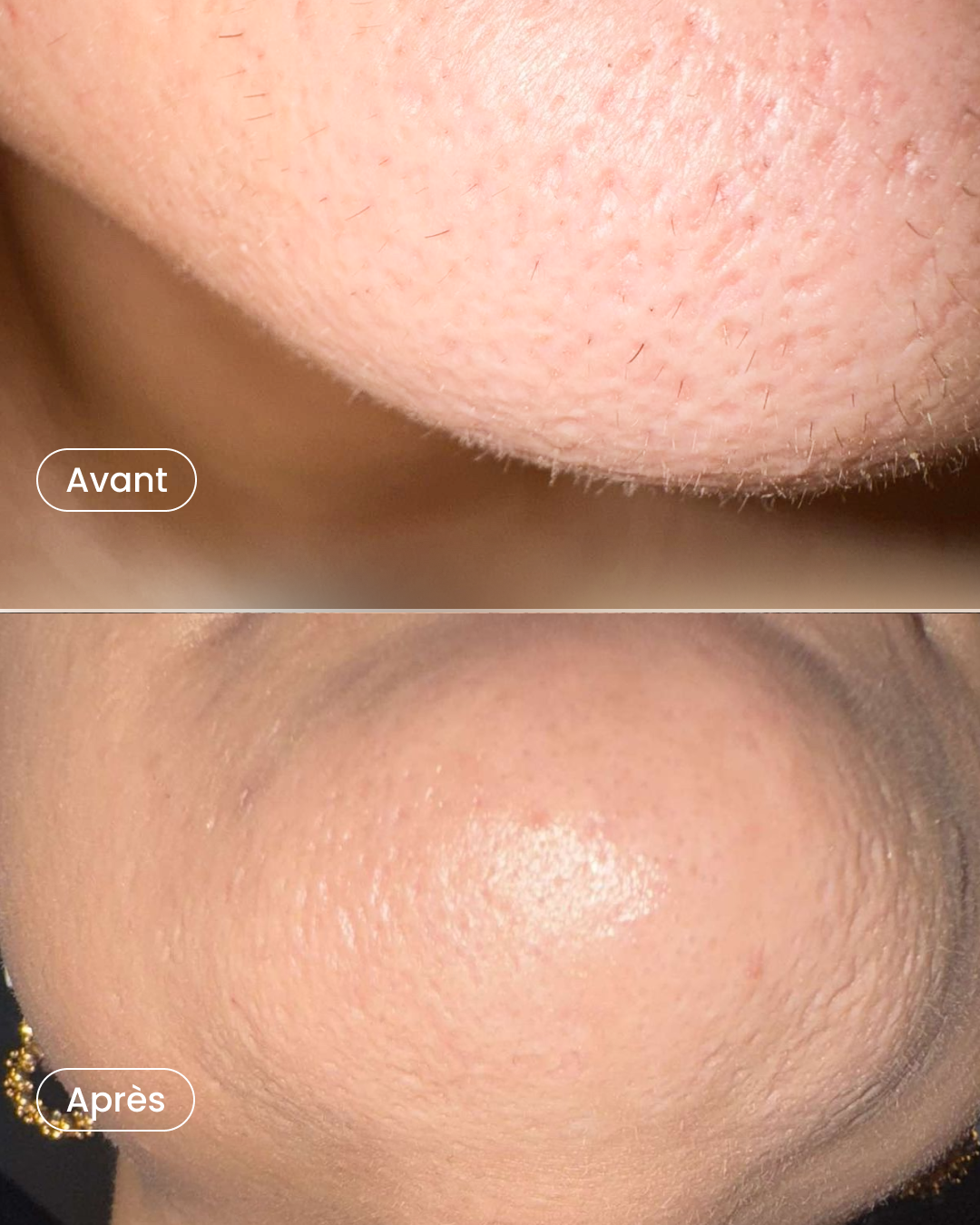 -40% sur 8 séances d’épilation laser pour 2 zones au choix