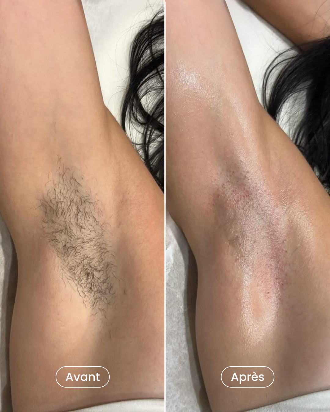 Pack épilation laser aisselles + maillot + jambes