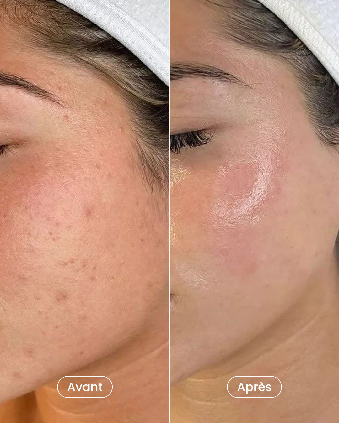 6-session Mesotherapy Package