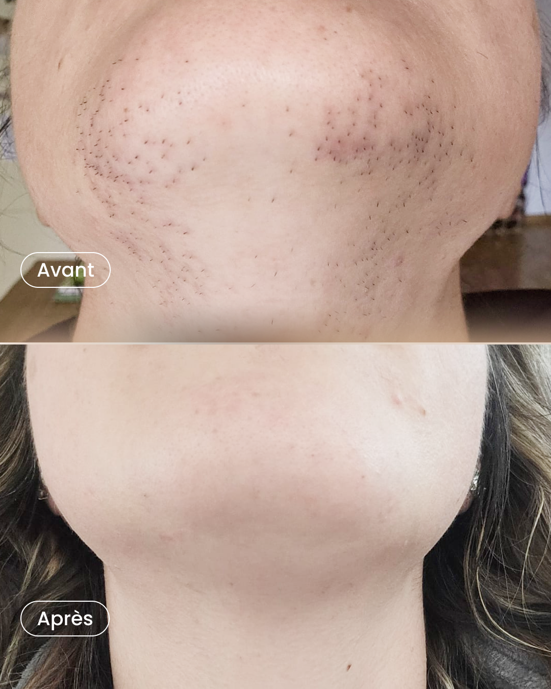 -50% sur 3 zones épilation laser