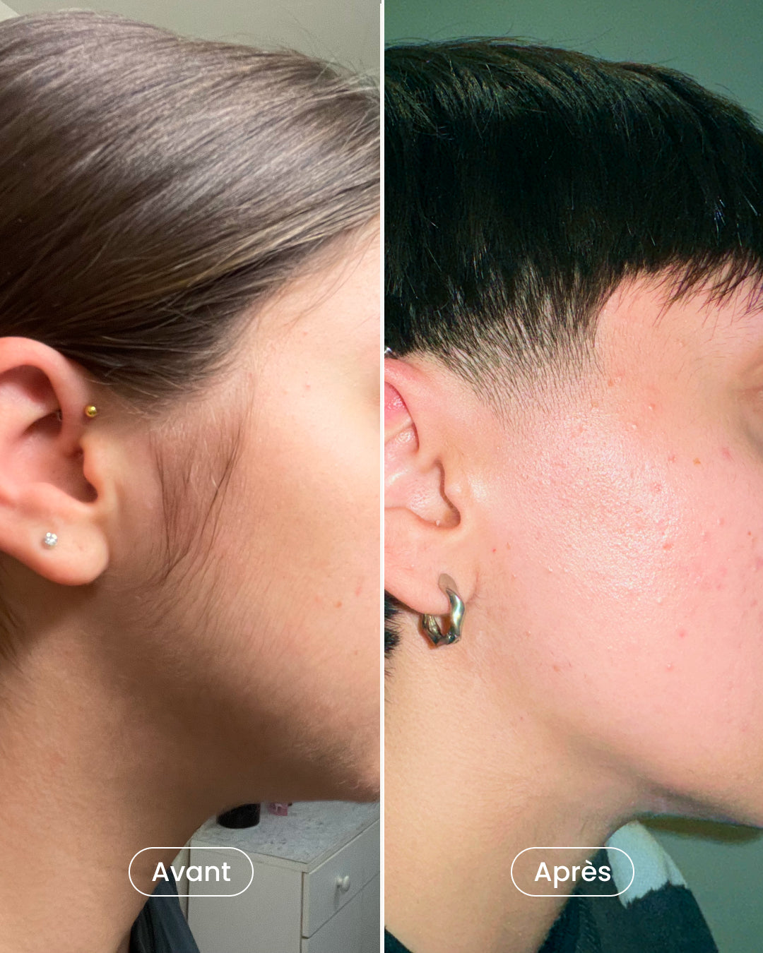 -40% sur 8 séances d’épilation laser pour 2 zones au choix