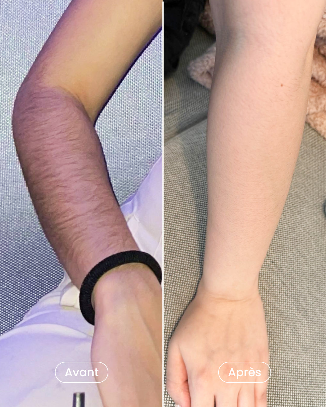 -40% sur 8 séances d’épilation laser pour 2 zones au choix