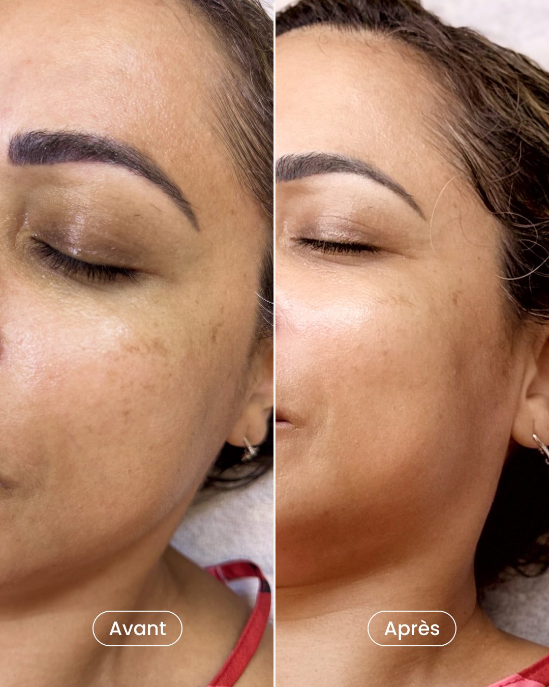 Radiance treatment