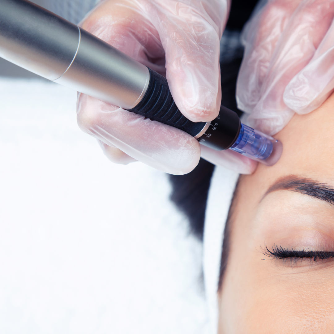 Traitement Microneedling