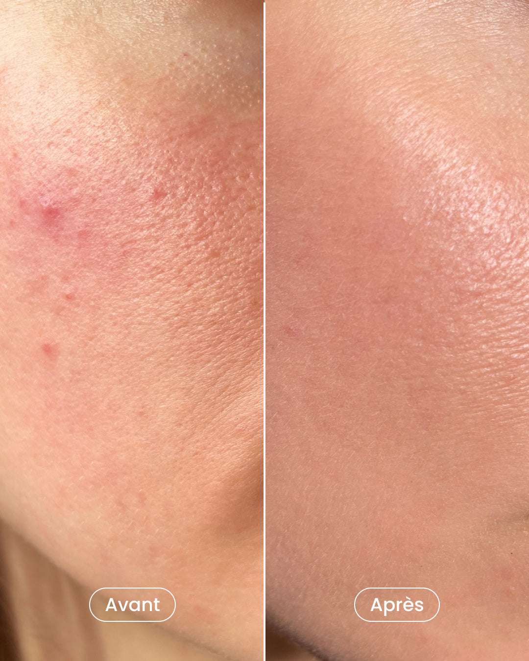 Peeling + Microneedling Treatment