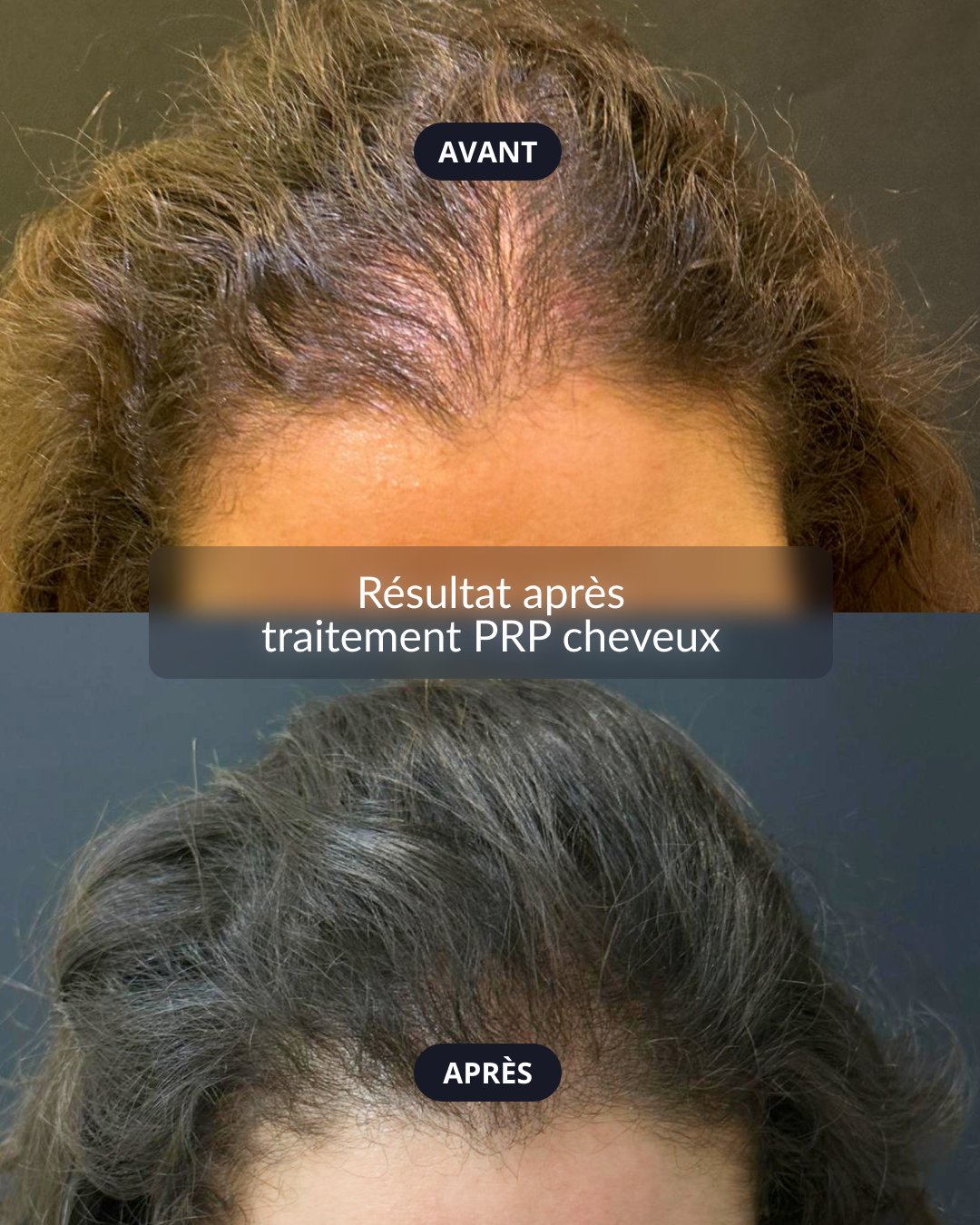 3 séances prp achetées → 1 séance gratuite offerte !