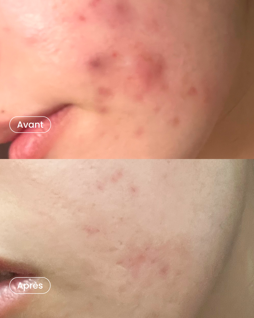 Microneedling OR mesotherapy package (your choice) + peeling + light therapy