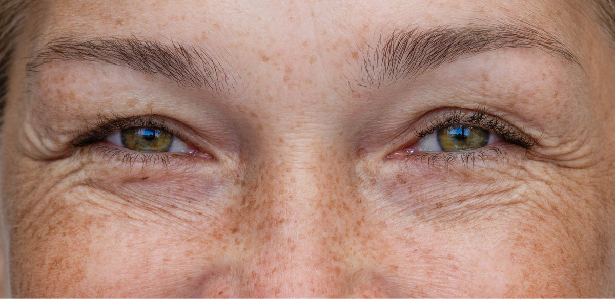 Ridules superficielles autour des yeux