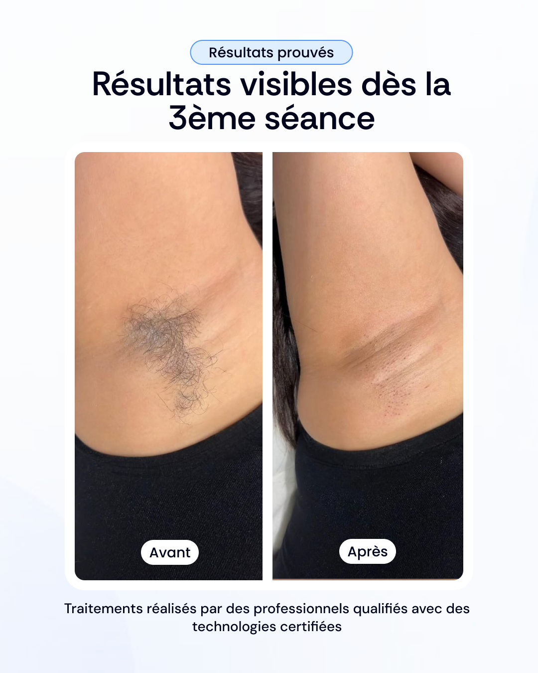 Vos 3 séances d'épilation laser à