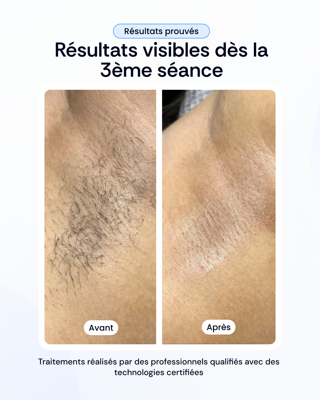 Vos 3 séances d'épilation laser à