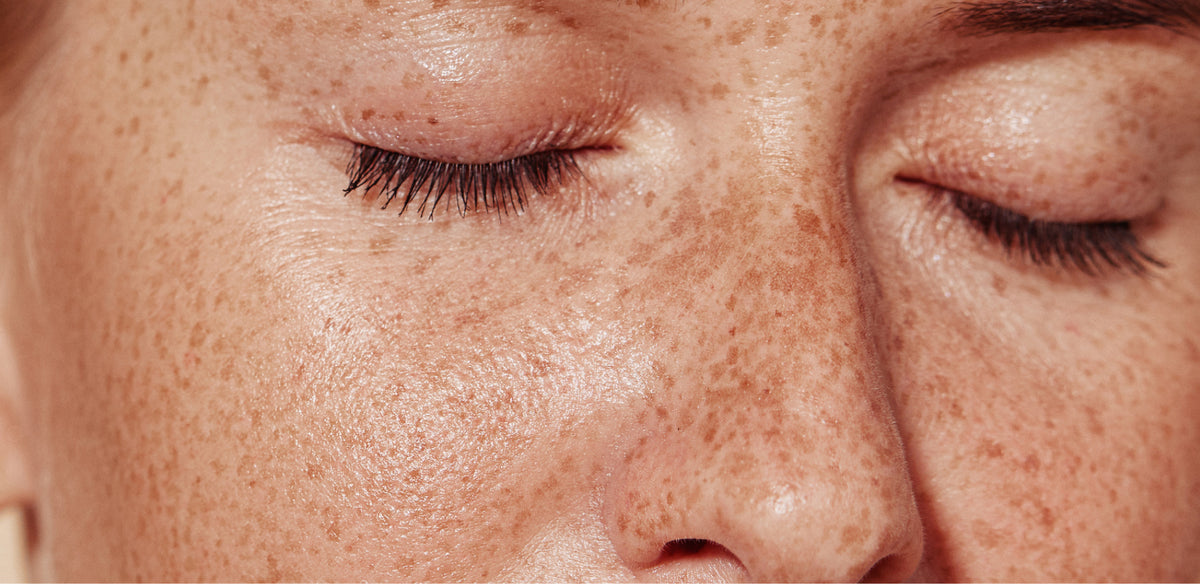 Taches de rousseur ou éphélides sur les joues