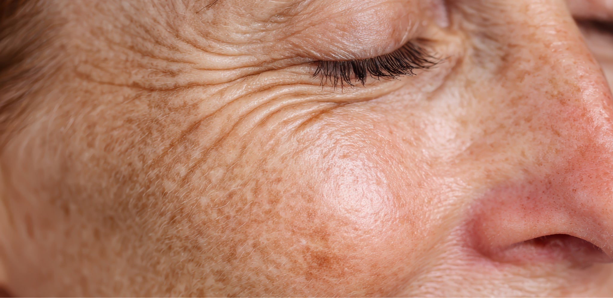 Taches de vieillesse ou lentigos solaires sur la joue