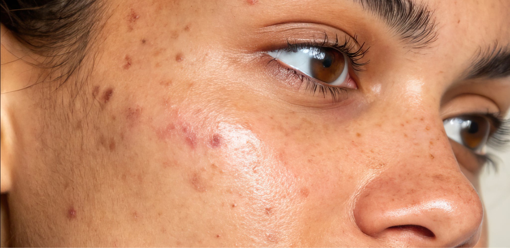 Taches post-inflammatoires sur la peau du visage