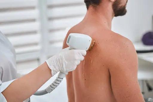 Dos poilu : faut-il opter pour l'épilation laser pour s'en débarrasser ?