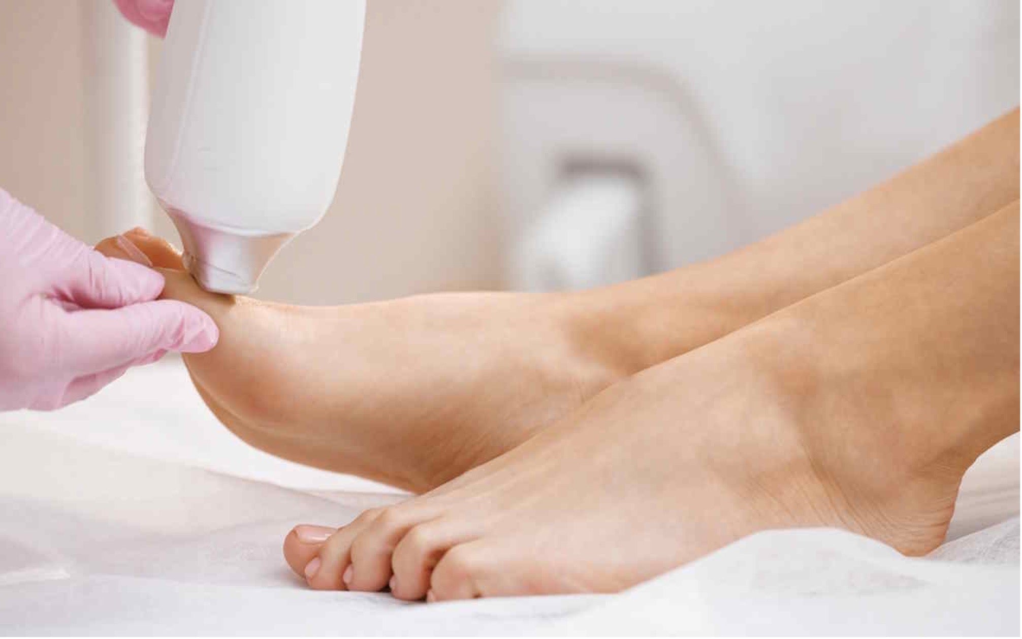 Épilation laser des pieds : éliminer les poils sur les orteils