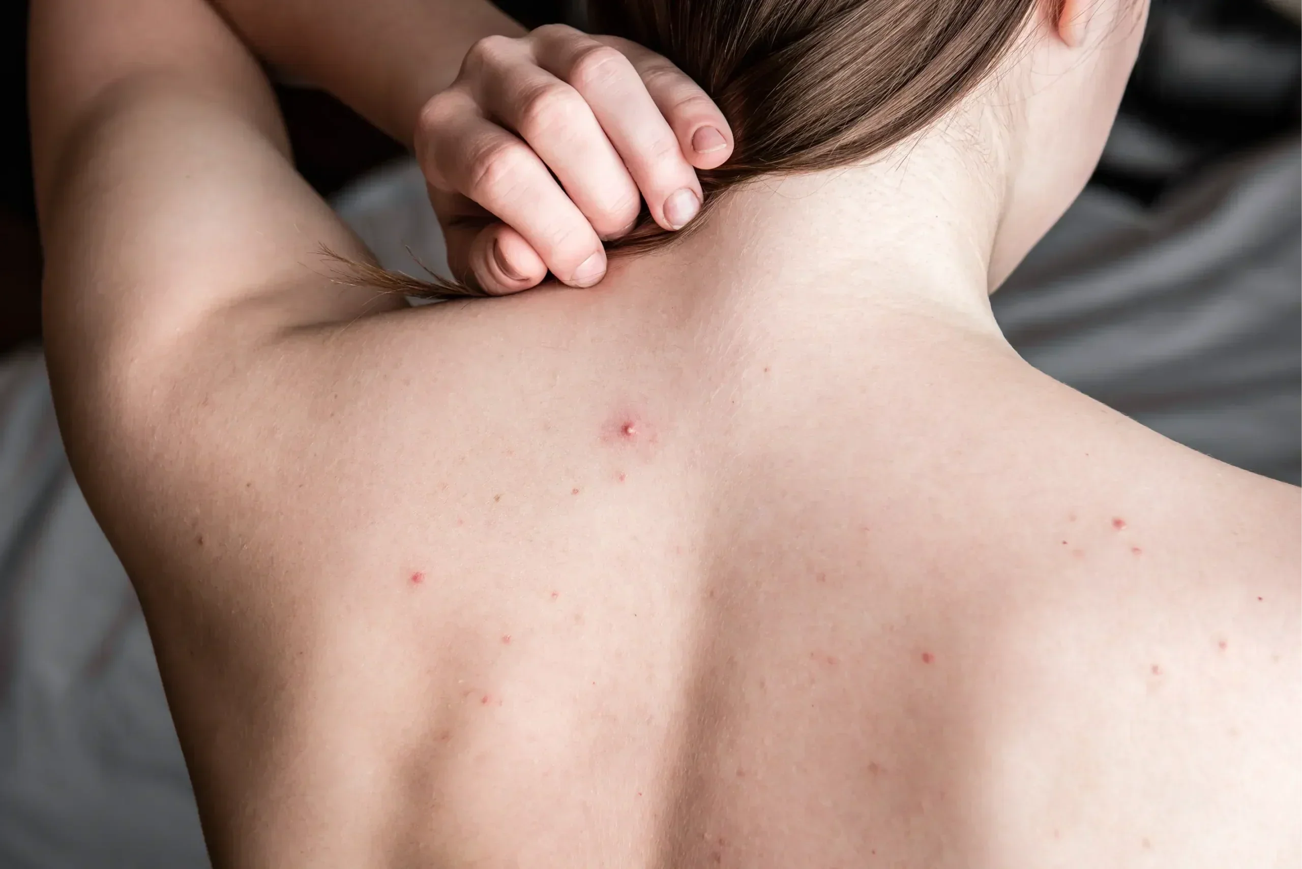 Acné du dos : causes, traitements et solutions pro
