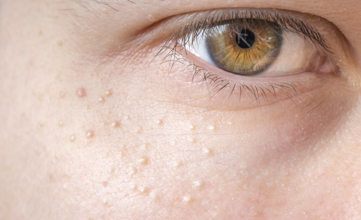 Grain de milium : symptômes et causes de ces minis kystes sur le visage