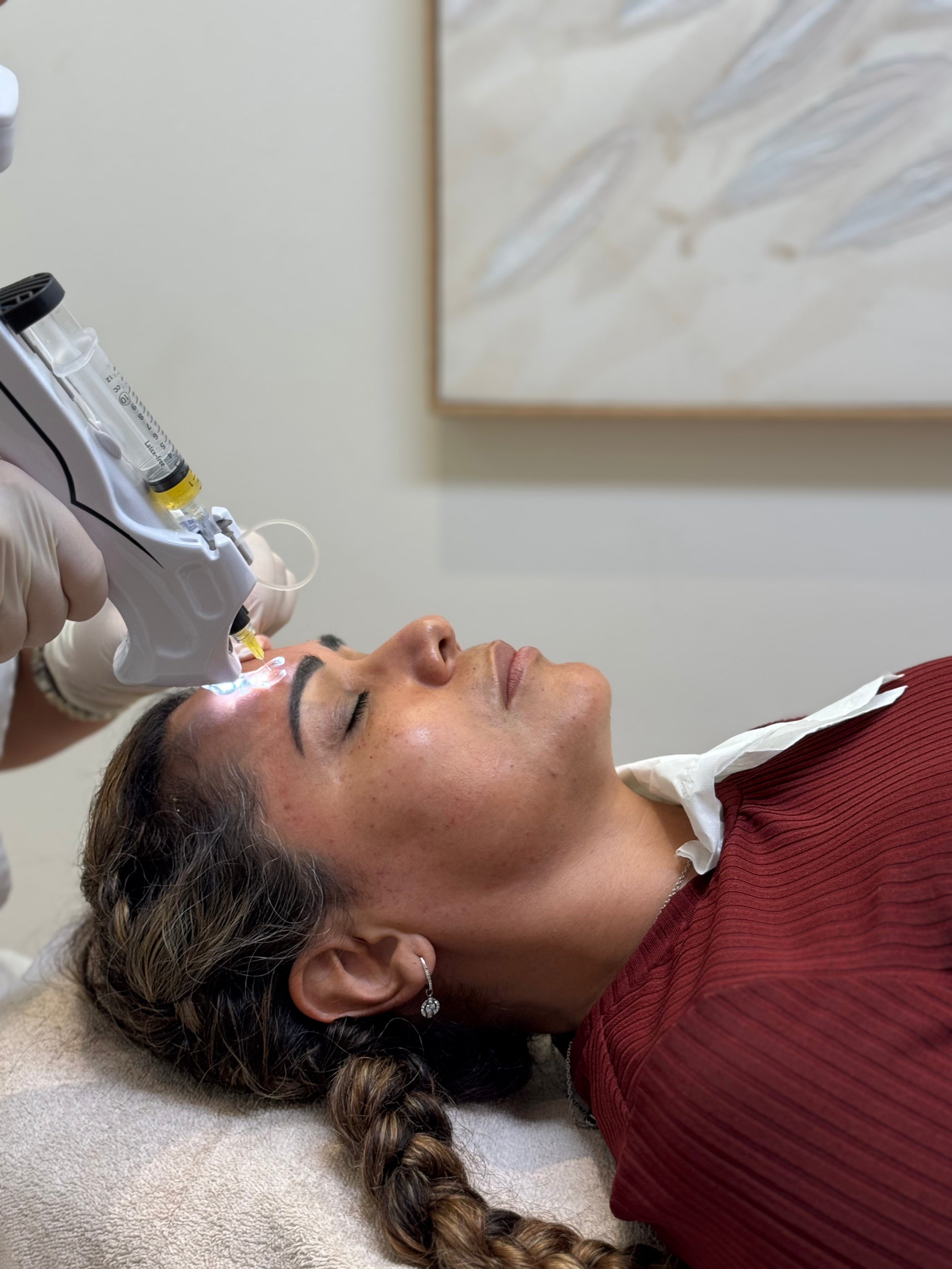 PRP facial treatment