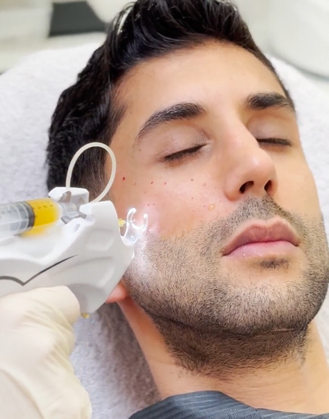 PRP facial treatment