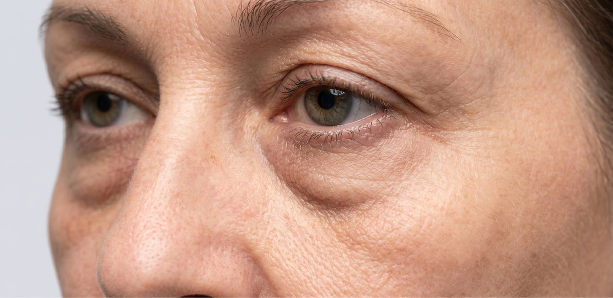Poches sous les yeux liées à une rétention d'eau ou une accumulation de graisse