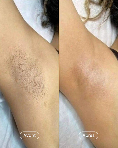 Pack épilation laser aisselles + maillot + jambes