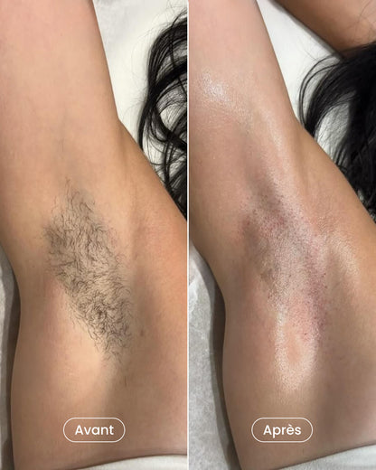 Pack épilation laser aisselles + maillot + jambes