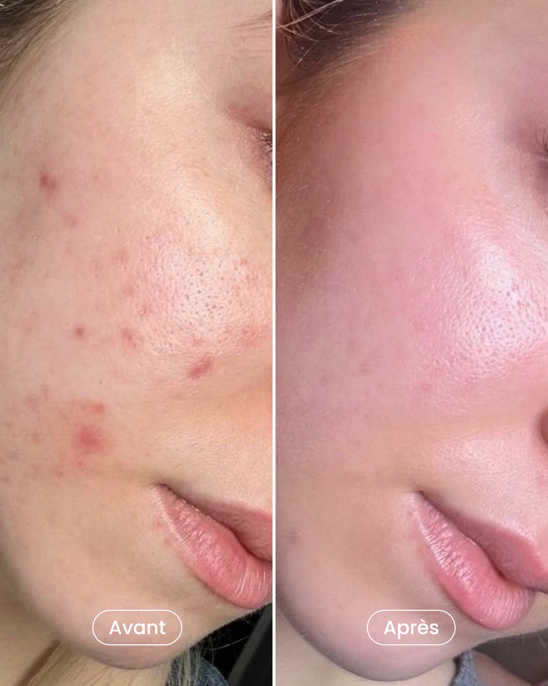 6-session Mesotherapy Package