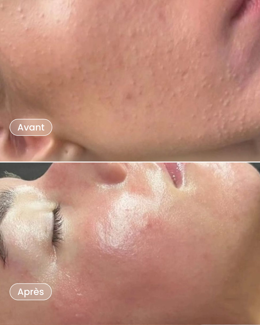 6-session Mesotherapy Package