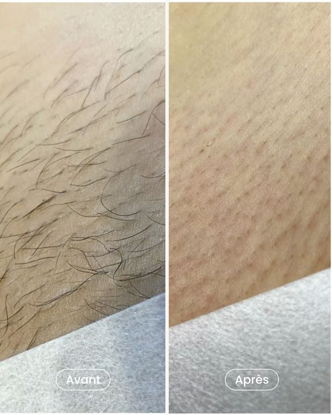 Pack épilation laser aisselles + maillot + jambes