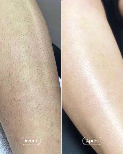 Pack épilation laser aisselles + maillot + jambes