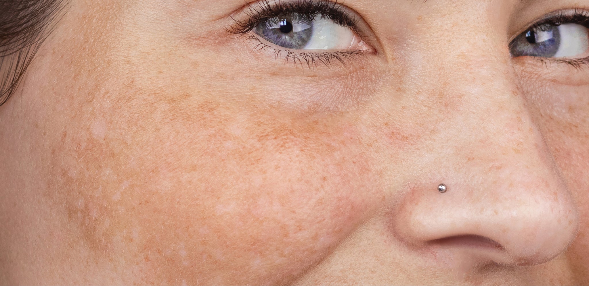 Mélasma, plaques brunes diffuses sur le visage