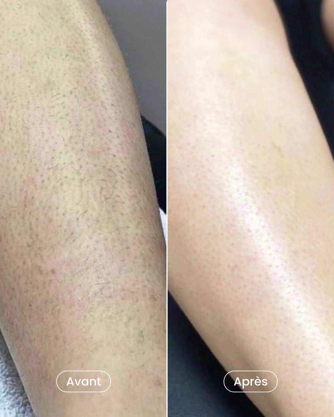 Résultat avant après épilation laser à la jambe