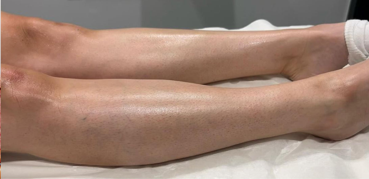 Résultats de l'épilation laser après 2 séances et après 8 séances