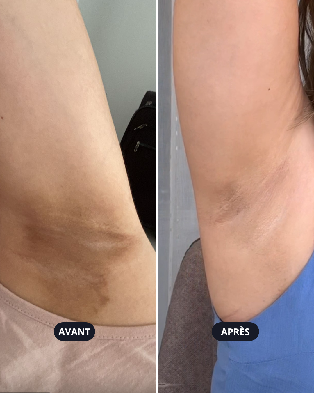 Résultats avant après épilation laser à l'aisselle