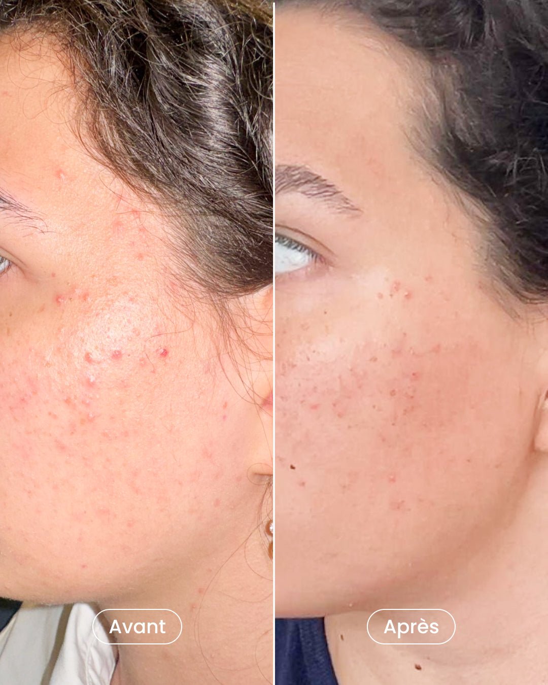 Radiance treatment 