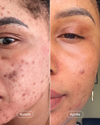 Radiance treatment 
