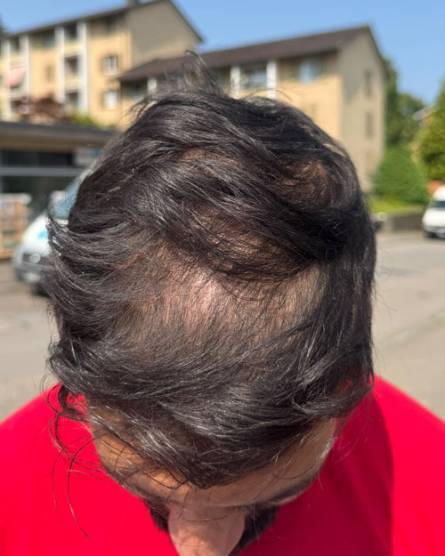 Before treatment - Taha, 35 ans