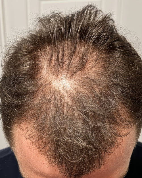 Before treatment - Louis, 29 ans