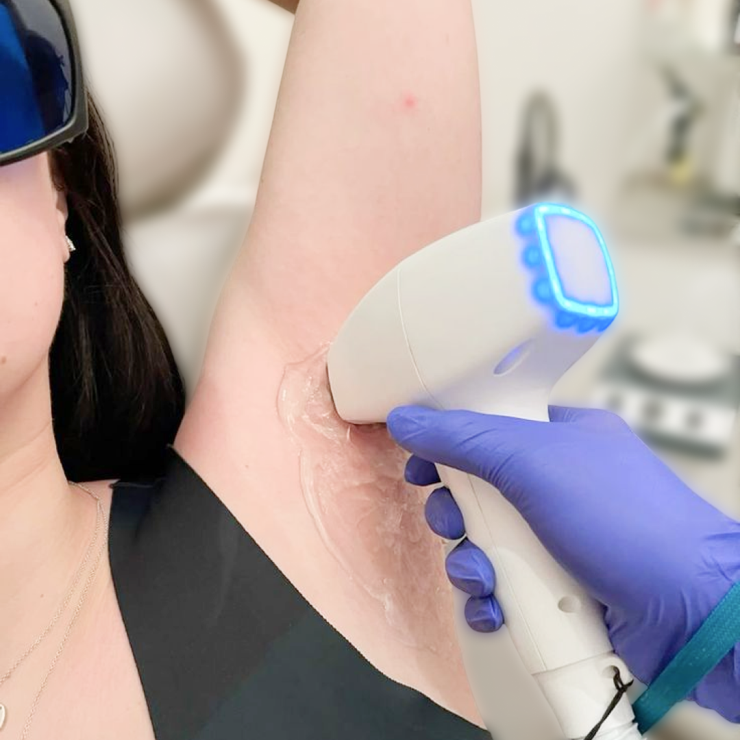 Épilation Laser