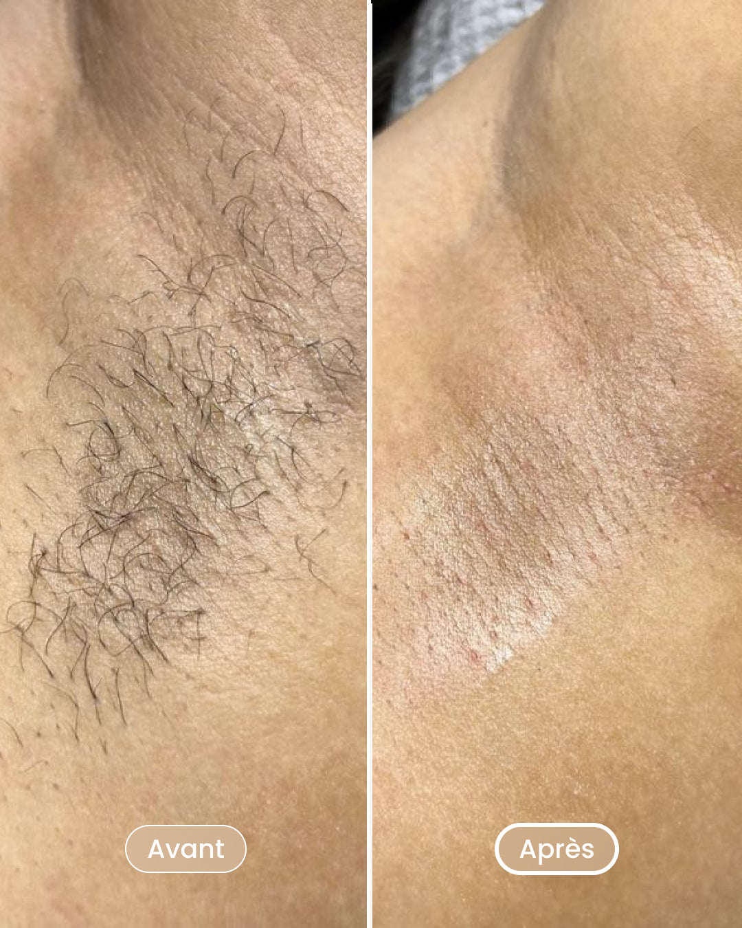 Laser hair removal pack 8 sessions