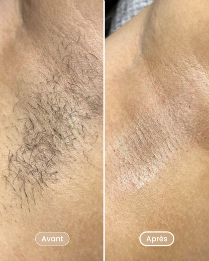 Laser hair removal pack 8 sessions