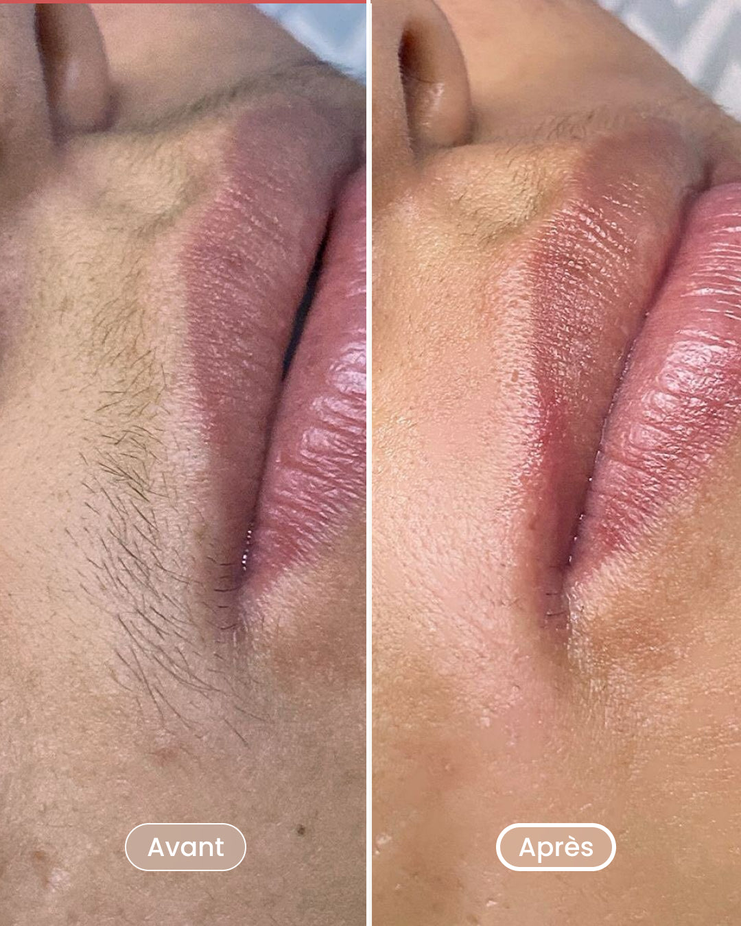 Laser hair removal pack 8 sessions