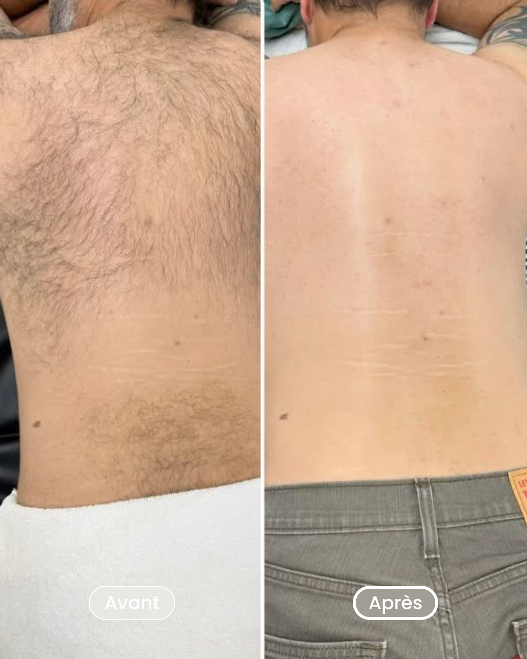 Laser hair removal pack 8 sessions